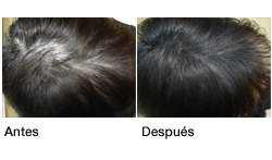 Tratamiento capilar con láser